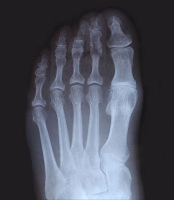 ToesXray3.jpg - small